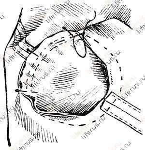 Схема втачивания рукава в пройму