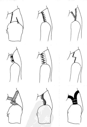 Застежки на плече